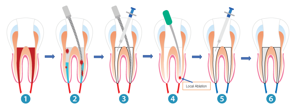 FOR IMMEDIATE RELEASE: AMD Lasers to Introduce Breakthrough Laser Root Canal Disinfection Technology at the 2026 AAE Annual Meeting