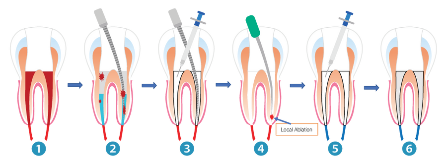FOR IMMEDIATE RELEASE: AMD Lasers to Introduce Breakthrough Laser Root ...