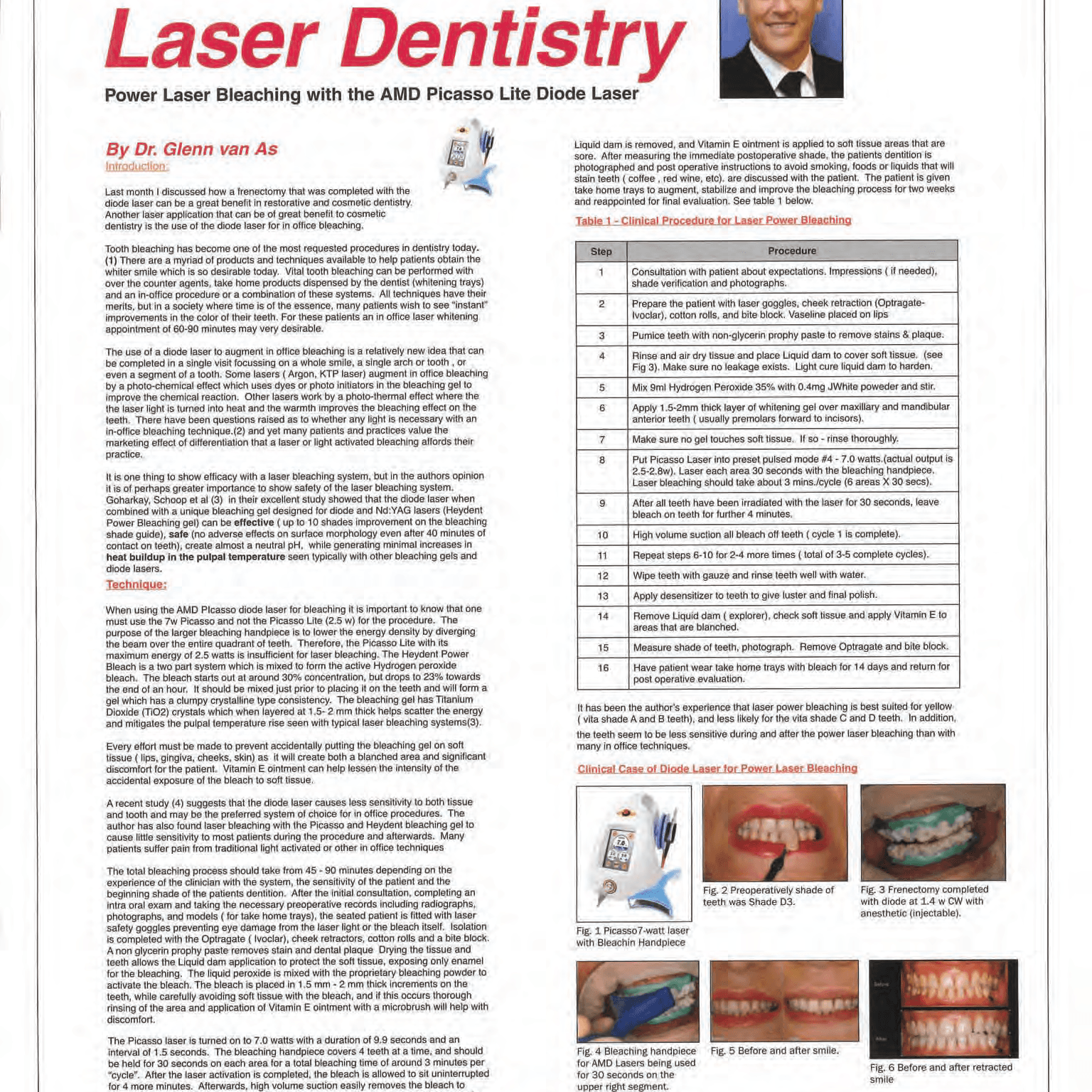 Laser Assisted Bleaching Guide - amdlasers